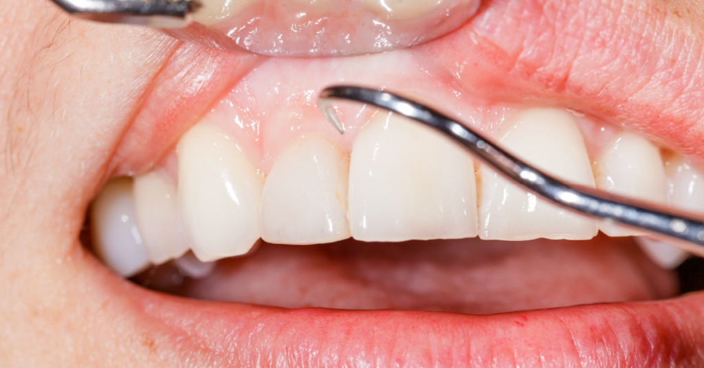 Laser Treatment Gums