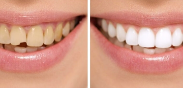 WEDDING-SMILE-MAKEOVER