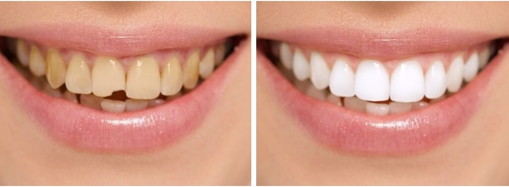 Wedding Smile Makeover