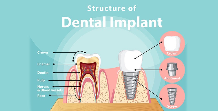 why dental work is expensive
