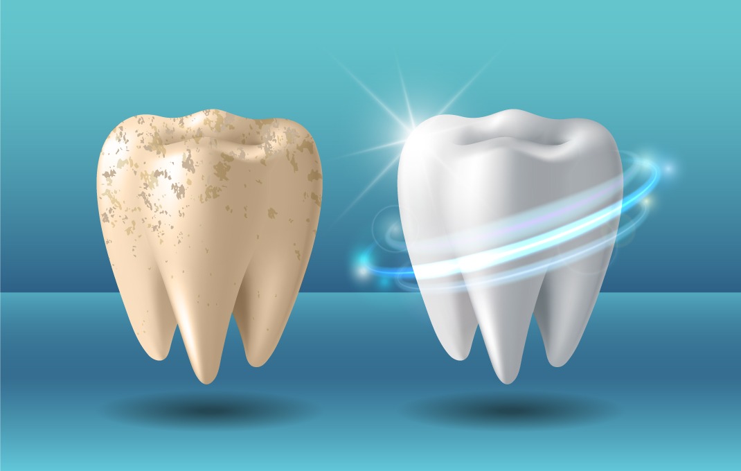 Zoom Teeth Whitening
