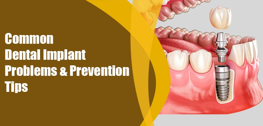 Common Dental Implant Problems & Prevention Tips