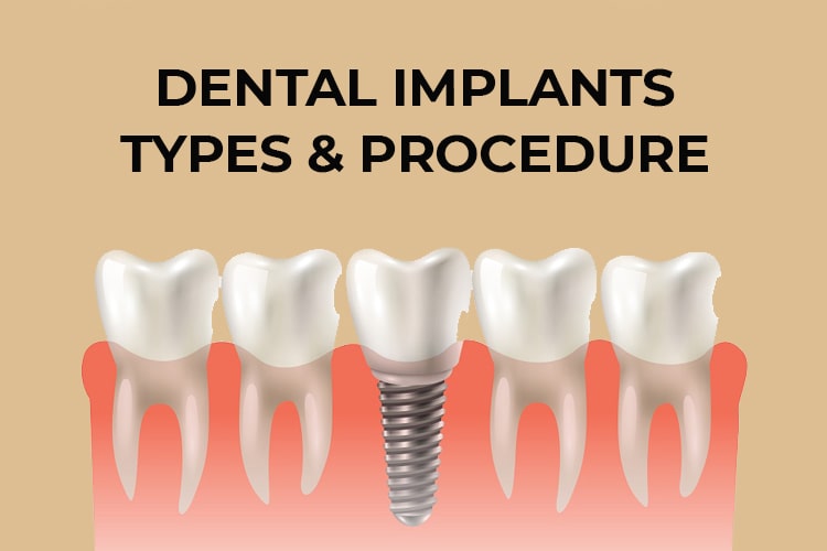 dental implants