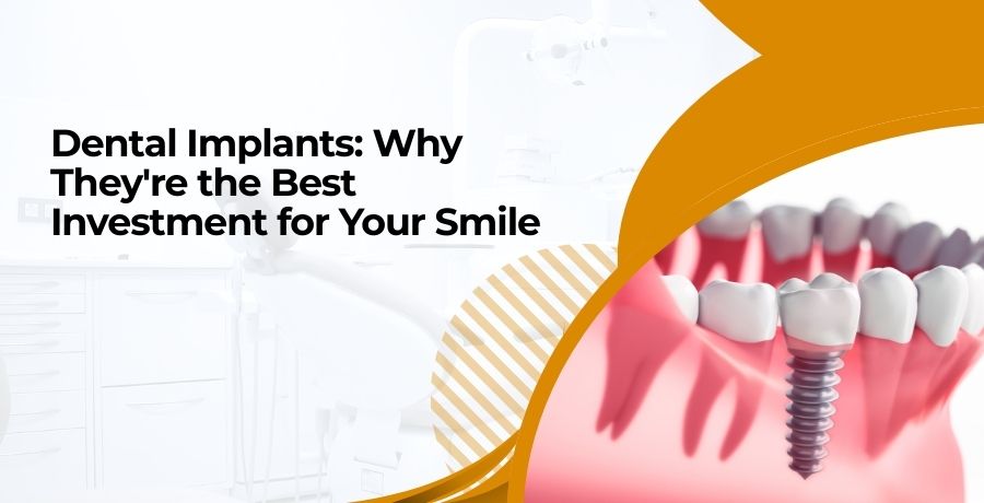 Bollywood Smile with Veneers