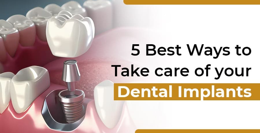 dental implants care