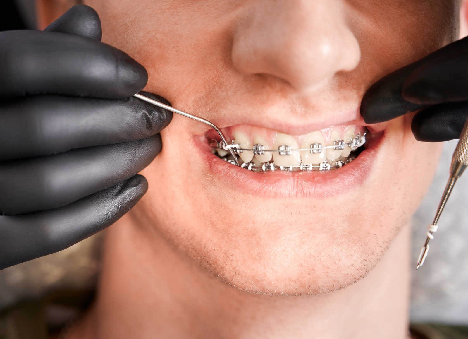 how-braces-work