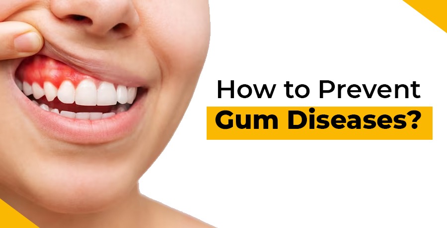 how to prevent gum diseases