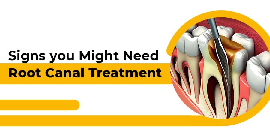 root canal treatment