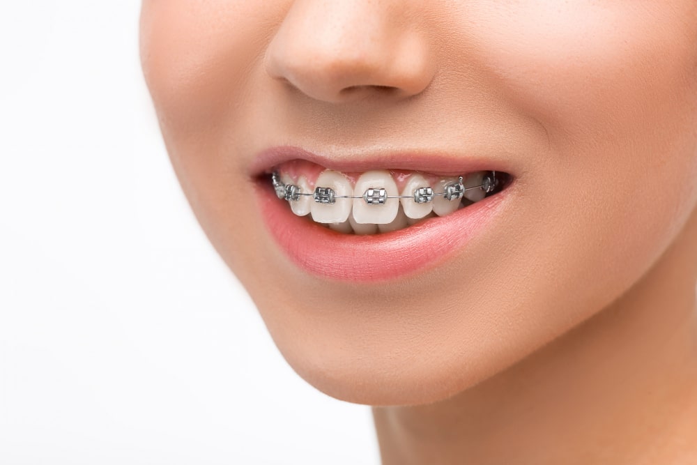 Teeth Braces