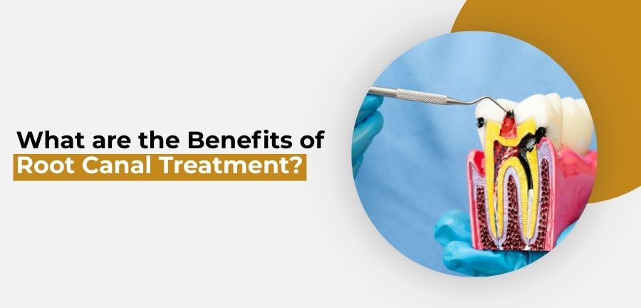 Benefits of Root Canal Treatment