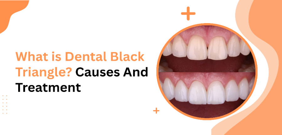 What is Dental Black Triangle?