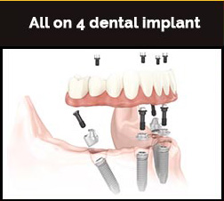 Dental Implants In Gurgaon