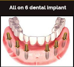 Dental Implants