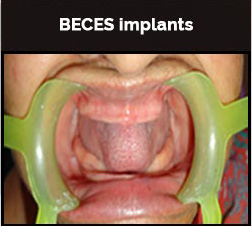 BECES Implant