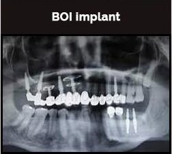 BOI Implant