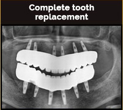 Complete tooth Replacement