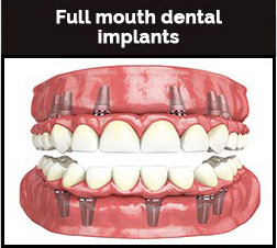 Full Mouth Dental Implants