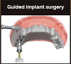Guided implants Gurgery