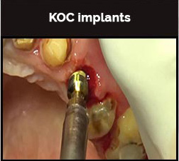 KOC Implant