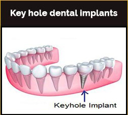 Key Hole Dental Implants
