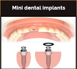 Mini dental Implants
