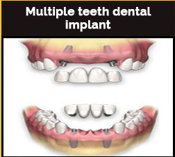 Multiple Teeth Dental Implants