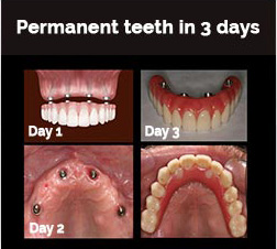 Permanent Teeth