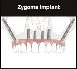 Zygoma Implant