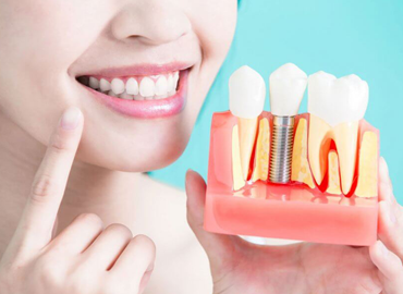 Dental Implants
