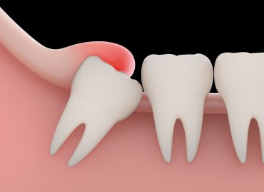 Wisdom Tooth Removal