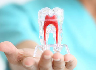 Root Canal Treatment